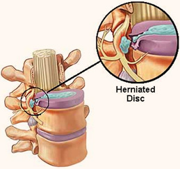 disc-prolapse