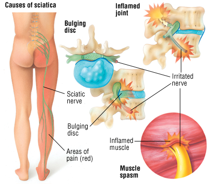 causes-of-sciatica